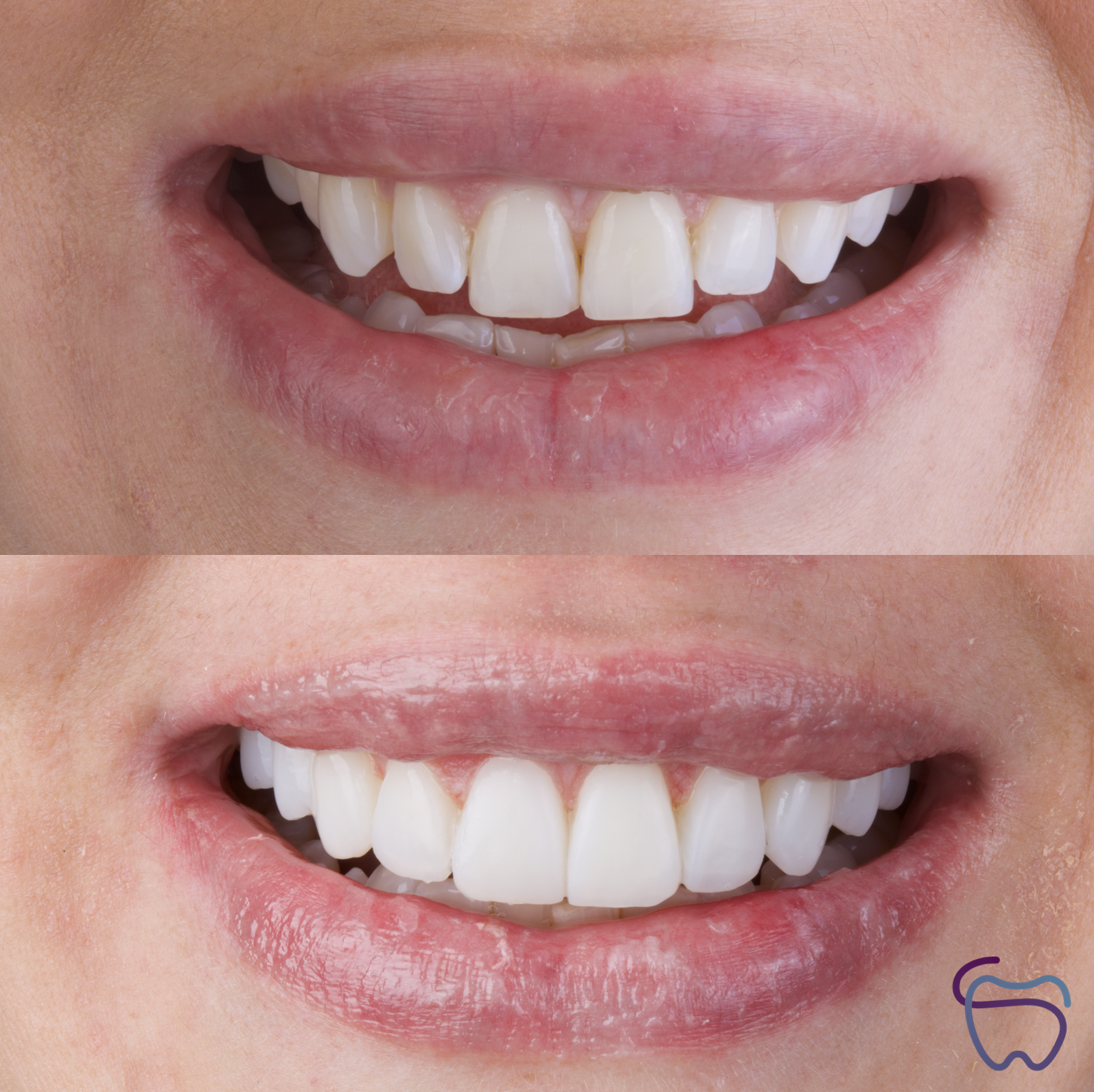 Antes y después de tratamiento dental realizado en Dentarte