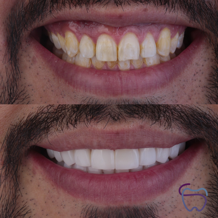 Resultado dental antes y después